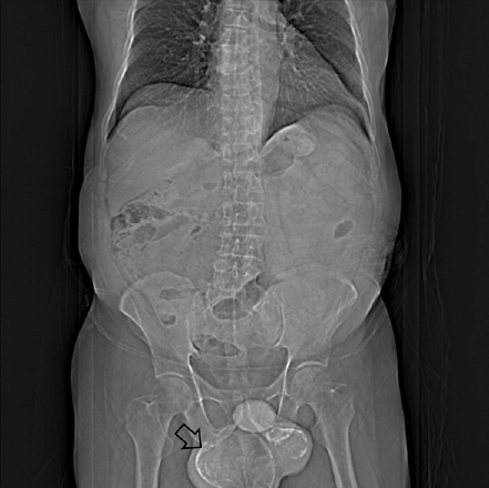Plain computed tomographic abdomen and pelvis showing peripheral rim of calcification of bilateral testis with no para-aortic lymphadenopathy.